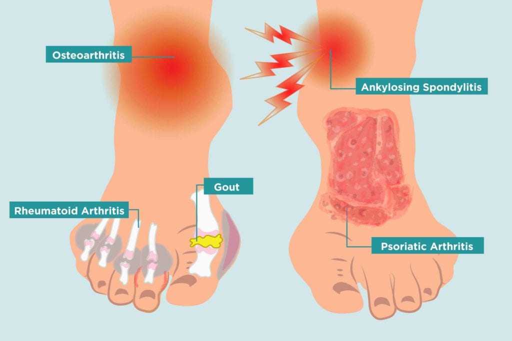 Seaweed reduces arthritis in the ankle with Pacific Seamoss