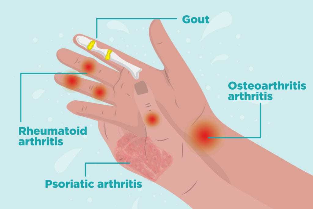 types of arthritis in hand 