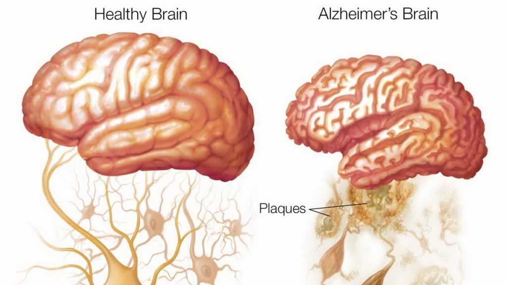 Reduction of brain with Alzheimer diseaser