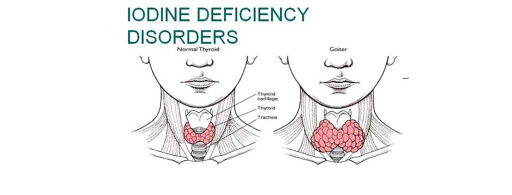 iodine level deficiency